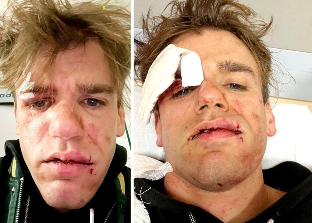 Faccia tumefatta e tanta paura: un famoso comico tv ridotto male dopo la rapina Faccia tumefatta e tanta paura: un famoso comico tv ridotto male dopo la rapina