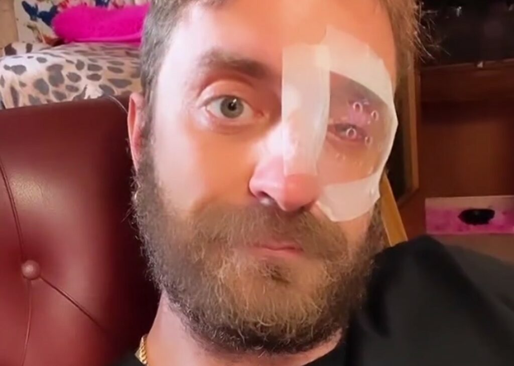 Stefano Corti ha perso la vista da un occhio dopo l'intervento? ''C'è da aspettare e sperare''