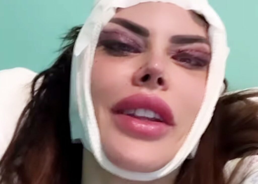 Guendalina Tavassi si mostra appena uscita dalla sala operatoria dopo un nuovo intervento di chirurgia plastica: ''Ecco cos'ho rifatto'' Guendalina Tavassi si mostra appena uscita dalla sala operatoria dopo un nuovo intervento di chirurgia plastica: ''Ecco cos'ho rifatto''