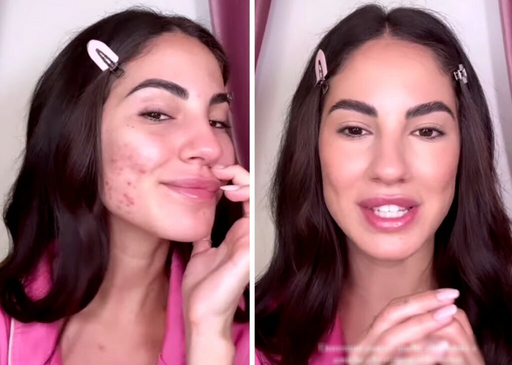 ''Ho avuto uno sfogo tremendo, mi vedo proprio brutta'': Giulia De Lellis mostra il ritorno dell'acne sul suo viso ''Ho avuto uno sfogo tremendo, mi vedo proprio brutta'': Giulia De Lellis mostra il ritorno dell'acne sul suo viso