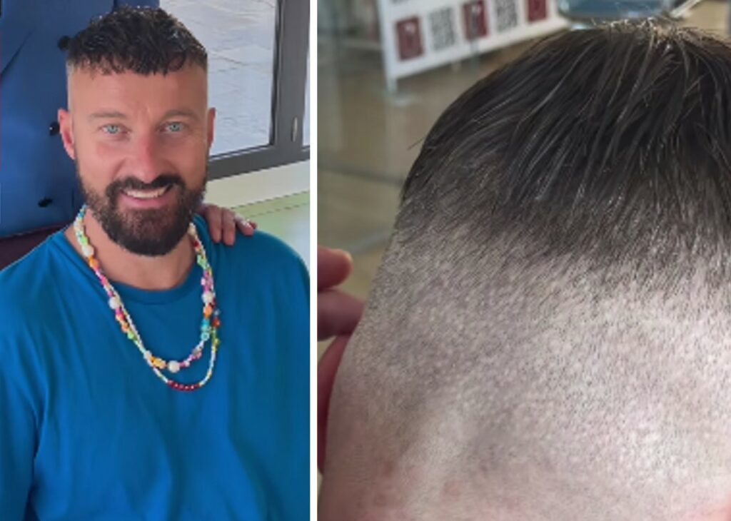 ''6mila bulbi e diecimila euro buttati'': Francesco Facchinetti mostra i 'danni' dell’inutile trapianto di capelli ''6mila bulbi e diecimila euro buttati'': Francesco Facchinetti mostra i 'danni' dell’inutile trapianto di capelli