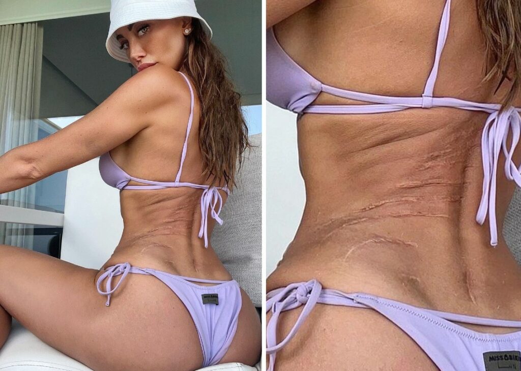 La modella Alessia Tedeschi mostra le enormi cicatrici a 10 anni dal terribile incidente in barca a Capri con Elisabetta Canalis: foto La modella Alessia Tedeschi mostra le enormi cicatrici a 10 anni dal terribile incidente in barca a Capri con Elisabetta Canalis: foto