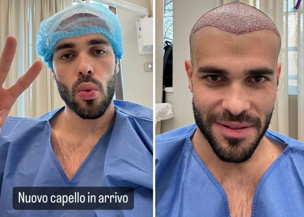 Goffredo Cerza, compagno di Aurora Ramazzotti, si è sottoposto a un trapianto di capelli e mostra tutto sul social: foto Goffredo Cerza, compagno di Aurora Ramazzotti, si è sottoposto a un trapianto di capelli e mostra tutto sul social: foto