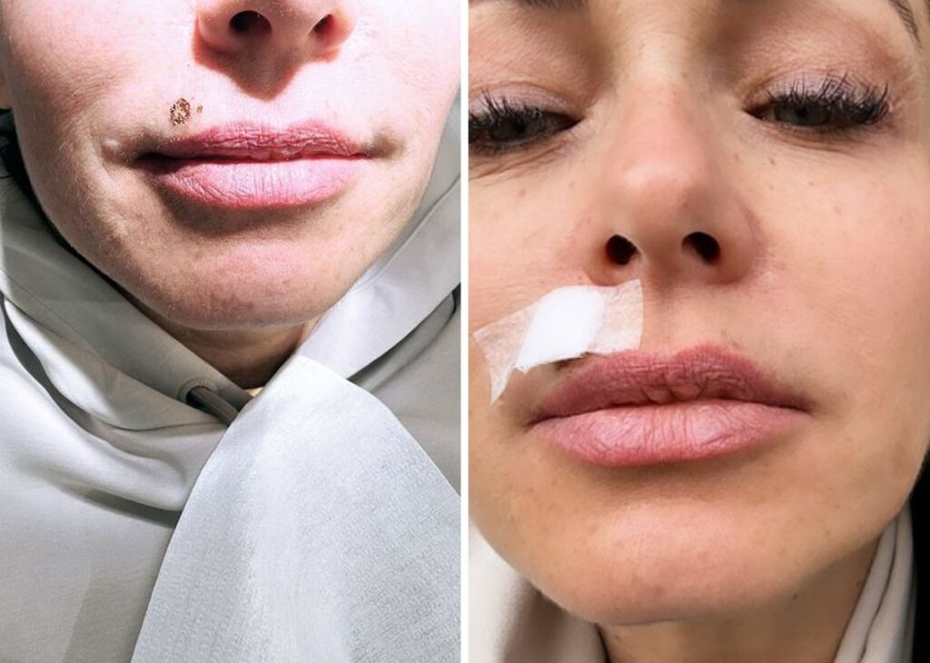 ''L’ho fatto'': Sonia Bruganelli si è sottoposta a un altro intervento di chirurgia estetica, le foto ''L’ho fatto'': Sonia Bruganelli si è sottoposta a un altro intervento di chirurgia estetica, le foto