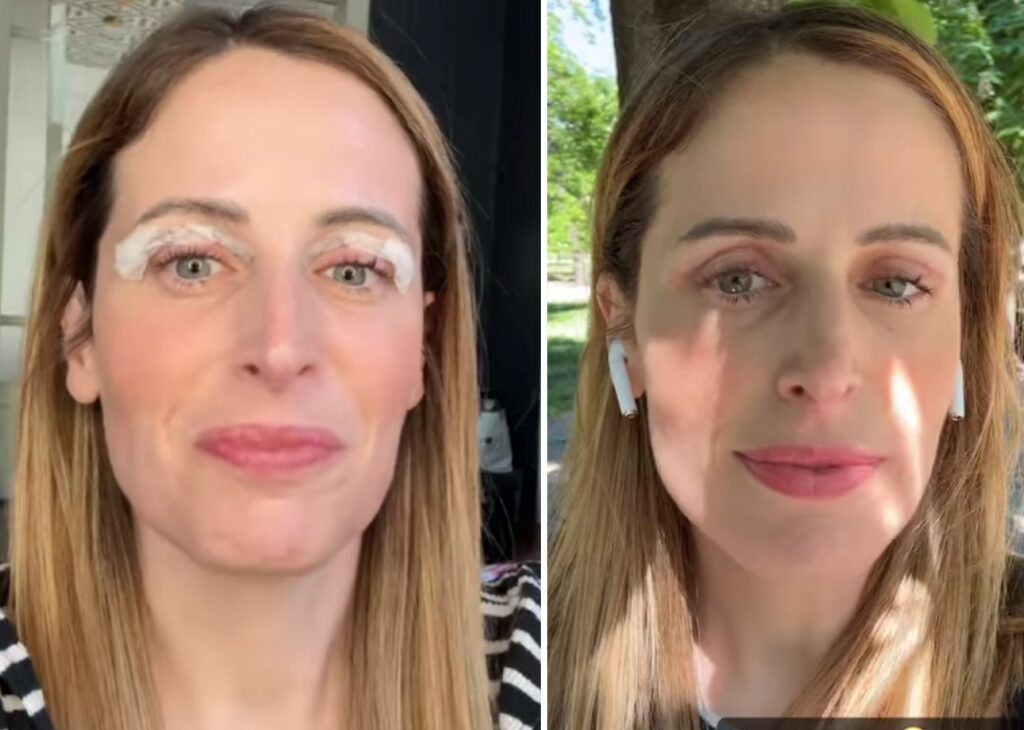 Clio MakeUp mostra gli occhi dopo aver rimosso i punti della blefaroplastica: guarda Clio MakeUp mostra gli occhi dopo aver rimosso i punti della blefaroplastica: guarda