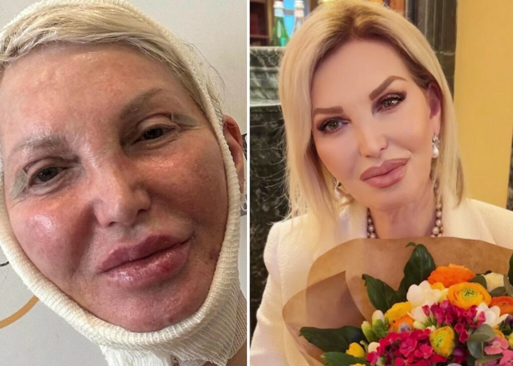 ''Mi mostro così per farvi venire un po' di invidia'': la Marchesa d'Aragona si fa vedere dopo il lifting al viso ''Mi mostro così per farvi venire un po' di invidia'': la Marchesa d'Aragona si fa vedere dopo il lifting al viso