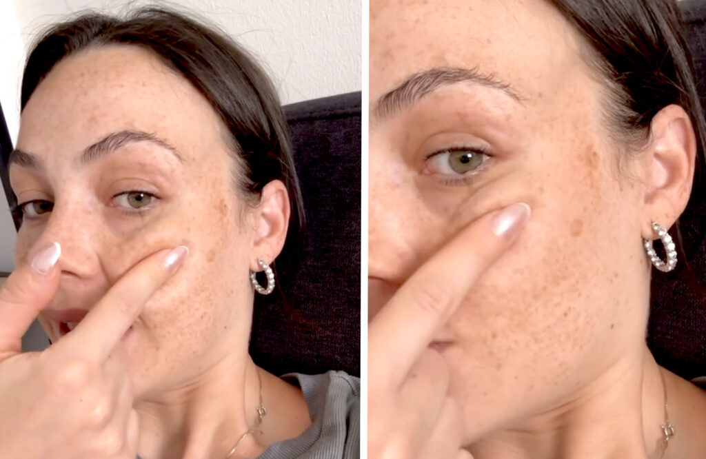 ''Queste macchie sono dovute alla gravidanza, non andranno via'': Rosalinda Cannavò mostra i segni della gestazione sul viso ''Queste macchie sono dovute alla gravidanza, non andranno via'': Rosalinda Cannavò mostra i segni della gestazione sul viso