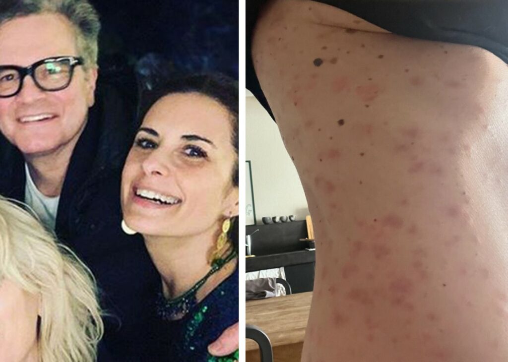 ''Sono letteralmente in fiamme, coperta da bolle a causa dello stress'': Livia Giuggioli, ex moglie italiana di Colin Firth, mostra foto forti