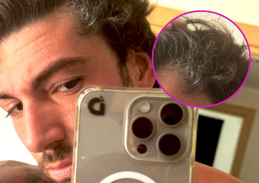 ''Ti sposi e subito arrivano i capelli bianchi'': Ignazio Moser dopo il matrimonio mostra la chioma improvvisamente imbiancata, foto