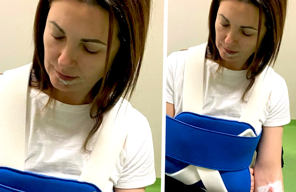 Sub-lussazione della spalla e tre punti di sutura sul viso dopo la corsa in ospedale: Giovanna Civitillo rivela cosa le è successo