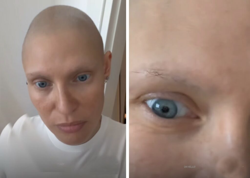 Bianca Balti felicissima: le stanno ricrescendo i capelli dopo la chemio e lo mostra orgogliosa ai follower, guarda Bianca Balti felicissima: le stanno ricrescendo i capelli dopo la chemio e lo mostra orgogliosa ai follower, guarda