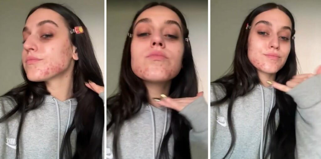 ''La mia pelle urla e chiede aiuto'': la cantante Gaia mostra lo sfogo cutaneo sul viso a causa del periodo che sta vivendo, guarda