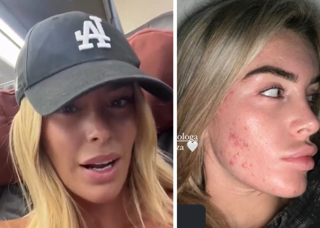 ''So cosa vuol dire evitare gli specchi'': Sophie Codegoni mostra il viso con forte acne e rivela di aver anche rimosso l'acido alle labbra ''So cosa vuol dire evitare gli specchi'': Sophie Codegoni mostra il viso con forte acne e rivela di aver anche rimosso l'acido alle labbra