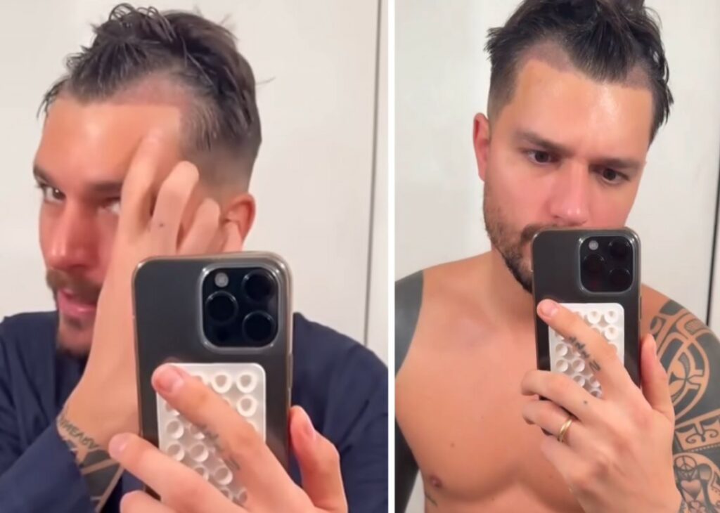 ''Era una cosa che volevo fare'': Andrea Zelletta si fa vedere sui social dopo il trapianto di capelli