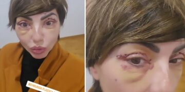 ''Ho tolto i punti'': l’ex Non è la Rai Ilaria Galassi si è sottoposta a un intervento di chirurgia estetica, ecco quale