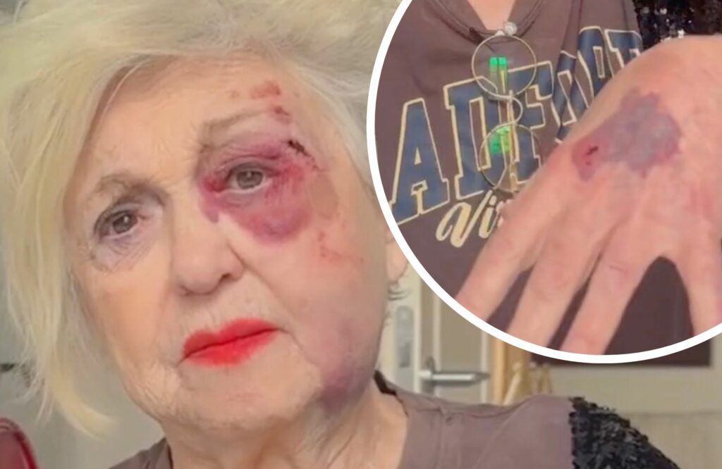 Ecchimosi e graffi: Wanna Marchi si mostra sul social ''devastata'', ecco cos’è successo