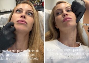 ''18.30 vengo a farmi il Botox'': Taylor Mega va da chirurgo estetico per un ritocchino salvifico, ecco quale ''18.30 vengo a farmi il Botox'': Taylor Mega va da chirurgo estetico per un ritocchino salvifico, ecco quale
