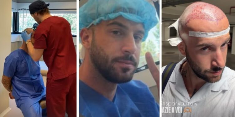 ''Non si torna più indietro!'': Andreas Muller ha deciso di risolvere il suo ‘problemino’ e si è sottoposto a un trapianto di capelli, guarda