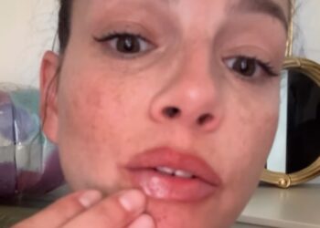 Emma Marrone e il solito herpes che le rovina i piani